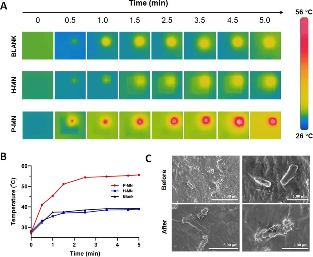 微針(MN)貼片上細菌的光熱消融圖